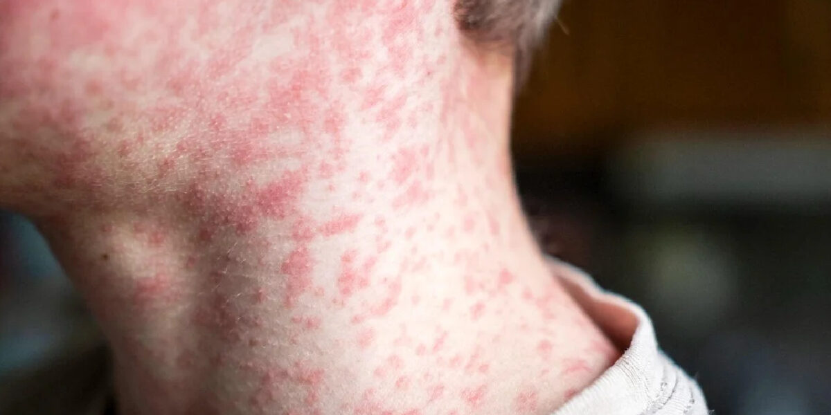 153 Unvaccinated Students Quarantined After Measles Exposure in South Carolina Schools